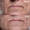 Mouth Wrinkle Patches
