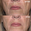 Mouth Wrinkle Patches